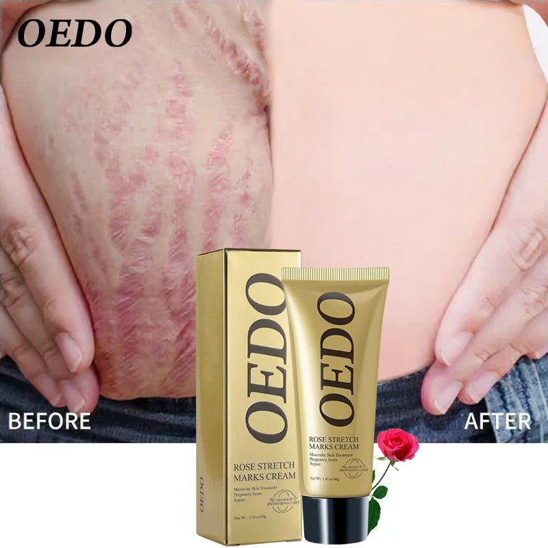OEDO Rose Remove Stretch Marks Cream Repair Stretch Marks Scars Restore Skin Elasticity Skin Care Promotes Cell Regeneration